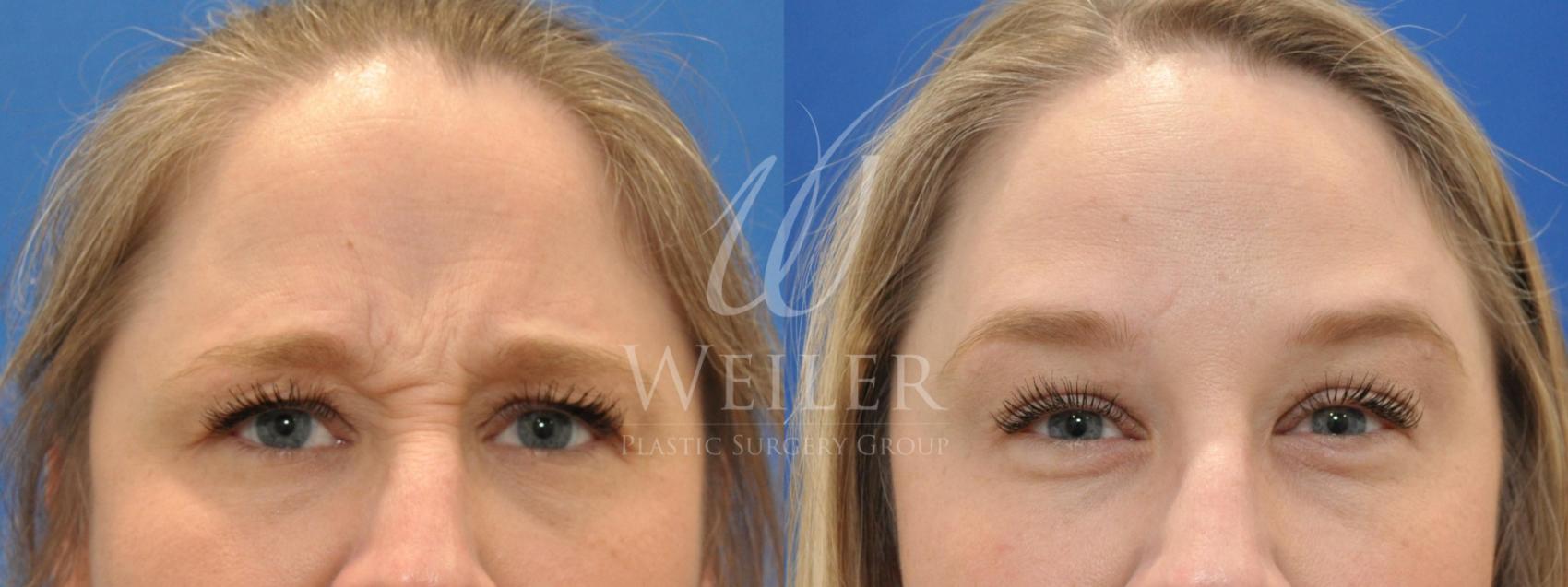 Before & After BOTOX® Cosmetic Case 492 Front View in Baton Rouge, New Orleans, & Lafayette, Louisiana