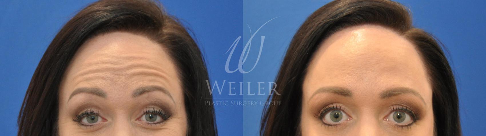 Before & After BOTOX® Cosmetic Case 522 Front View in Baton Rouge, New Orleans, & Lafayette, Louisiana