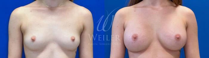 Before & After Breast Augmentation Case 1511 Front View in Baton Rouge, New Orleans, & Lafayette, Louisiana