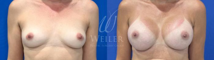 Before & After Breast Augmentation Case 1816 Front View in Baton Rouge, New Orleans, & Lafayette, Louisiana