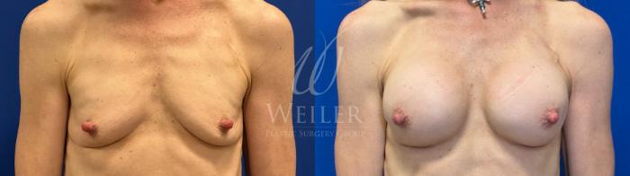 Before & After Breast Augmentation Case 1817 Front View in Baton Rouge, New Orleans, & Lafayette, Louisiana