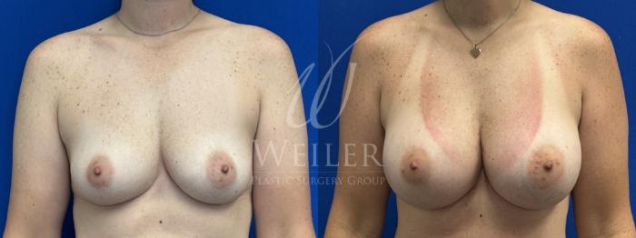 Before & After Breast Augmentation Case 1818 Front View in Baton Rouge, New Orleans, & Lafayette, Louisiana