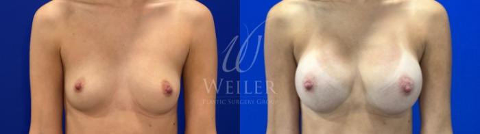 Before & After Breast Augmentation Case 1825 Front View in Baton Rouge, New Orleans, & Lafayette, Louisiana