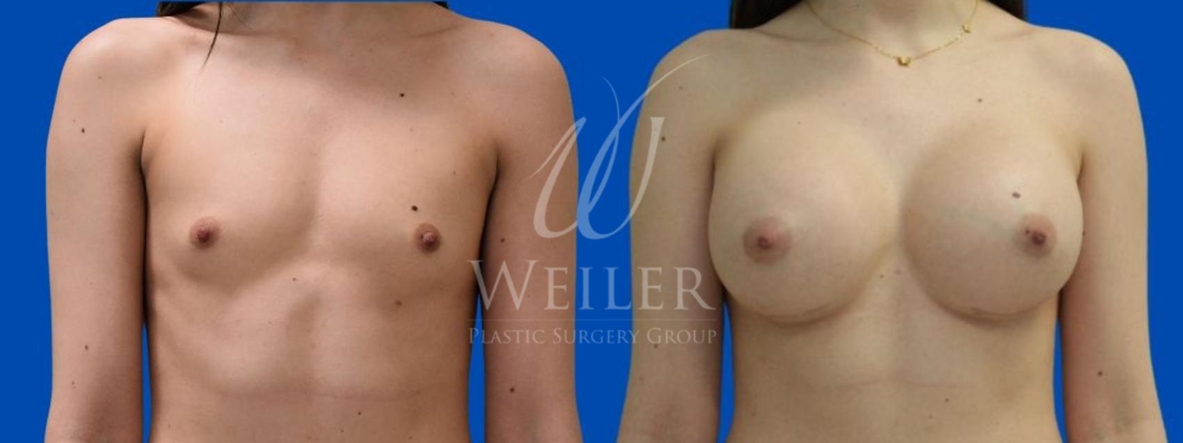 Before & After Breast Augmentation Case 430 View #1 View in Baton Rouge, New Orleans, & Lafayette, Louisiana