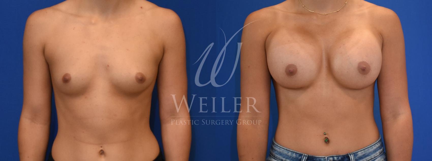 Before & After Breast Augmentation Case 747 Front View in Baton Rouge, New Orleans, & Lafayette, Louisiana