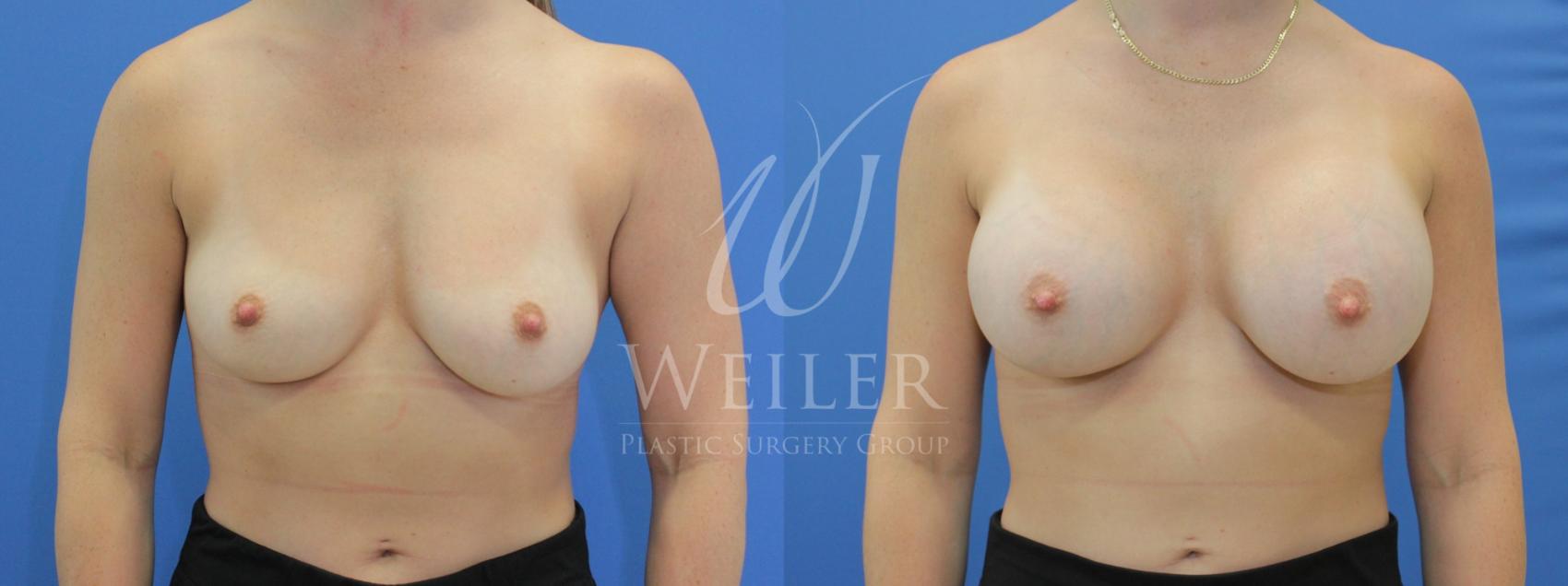 Before & After Breast Augmentation Case 777 Front View in Baton Rouge, New Orleans, & Lafayette, Louisiana