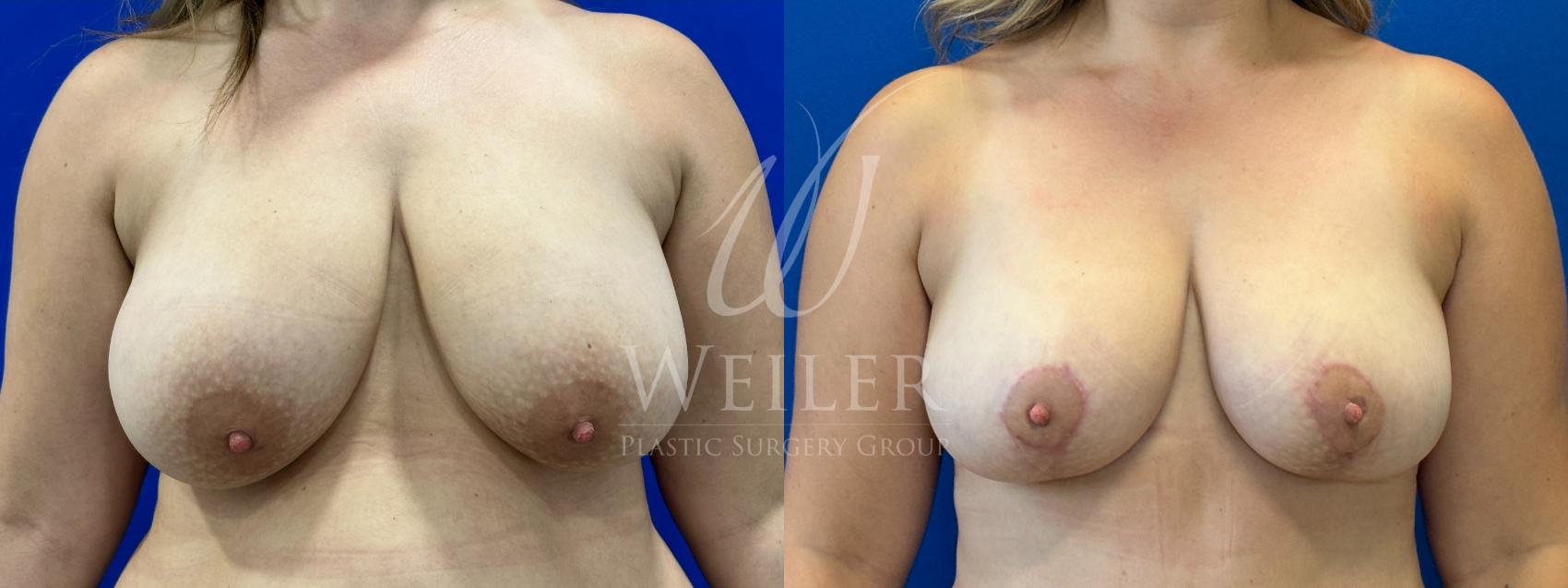 Before & After Breast Lift Case 1038 Front View in Baton Rouge, New Orleans, & Lafayette, Louisiana