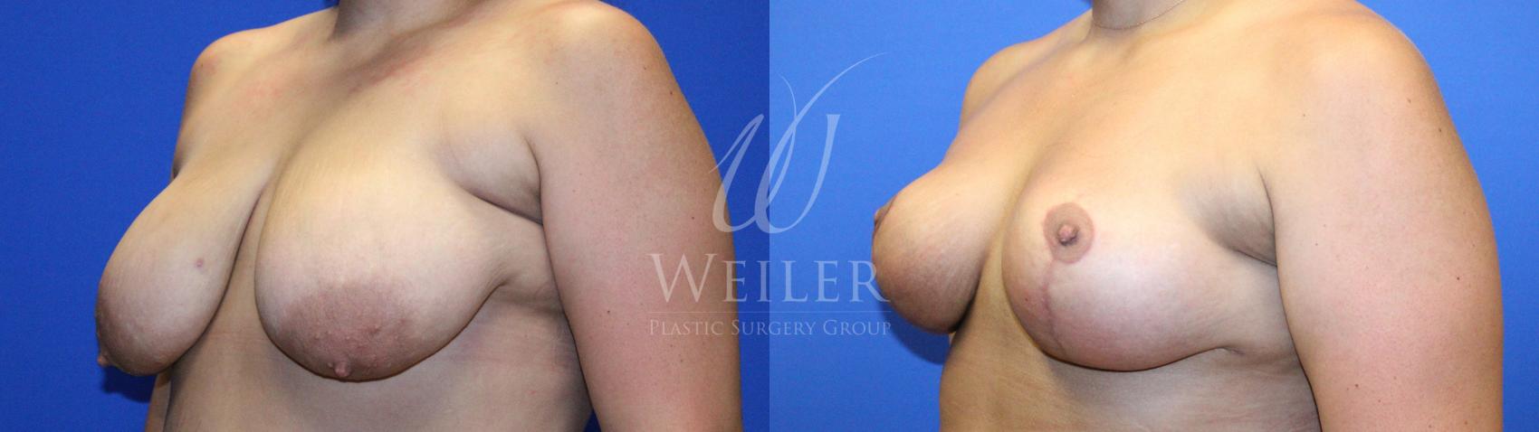 Before & After Breast Lift Case 1222 Left Oblique View in Baton Rouge, New Orleans, & Lafayette, Louisiana