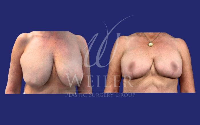 Before & After Breast Lift Case 1652 Front View in Baton Rouge, New Orleans, & Lafayette, Louisiana