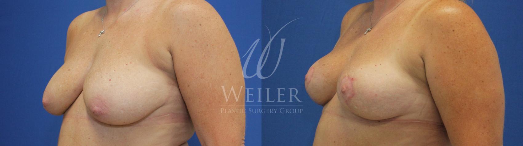 Before & After Breast Lift Case 658 Left Oblique View in Baton Rouge, New Orleans, & Lafayette, Louisiana