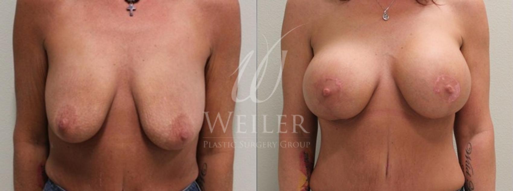 Before & After Breast Lift with Augmentation Case 105 View #1 View in Baton Rouge, New Orleans, & Lafayette, Louisiana