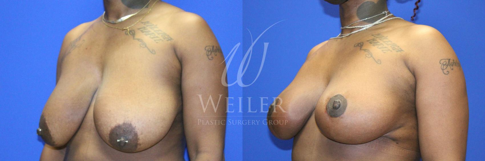 Before & After Breast Reduction Case 1132 Right Oblique View in Baton Rouge, Louisiana