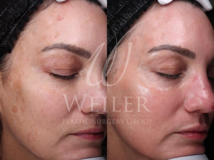 Before & After Chemical Peels Case 1598 Right Oblique View in Baton Rouge, New Orleans, & Lafayette, Louisiana
