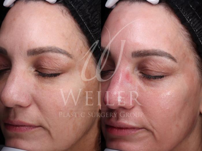 Before & After Chemical Peels Case 1610 Left Oblique View in Baton Rouge, New Orleans, & Lafayette, Louisiana