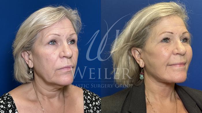 Before & After Deep Plane Facelift Case 1820 Right Oblique View in Baton Rouge, New Orleans, & Lafayette, Louisiana