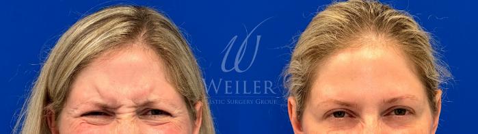 Before & After Dysport® Case 1319 Front View in Baton Rouge, New Orleans, & Lafayette, Louisiana