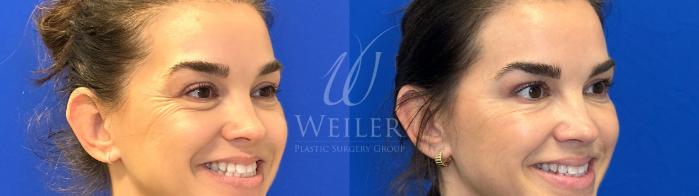 Before & After Dysport® Case 1776 Right Oblique View in Baton Rouge, New Orleans, & Lafayette, Louisiana