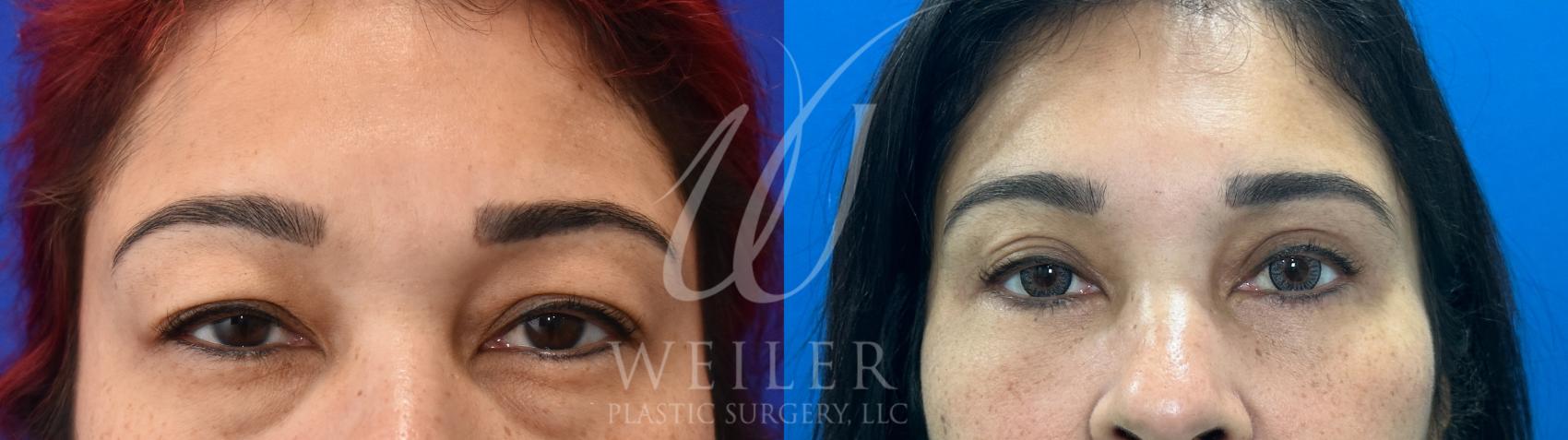 Before & After Eyelid Surgery Case 1050 Front View in Baton Rouge, Louisiana