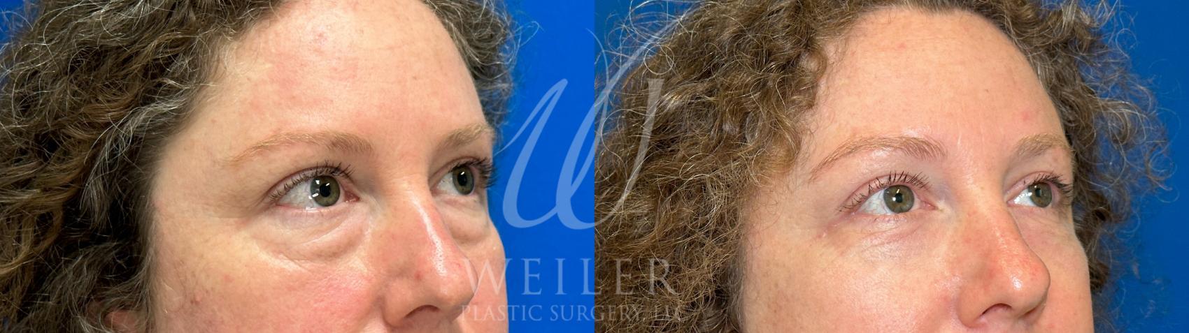 Before & After Eyelid Surgery Case 1082 Right Oblique View in Baton Rouge, Louisiana