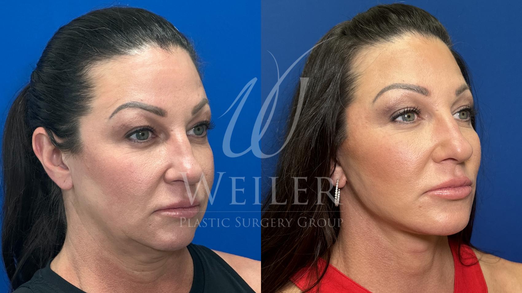 Before & After Facelift Case 1812 Right Oblique View in Baton Rouge, New Orleans, & Lafayette, Louisiana