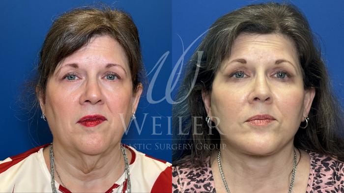 Before & After Facelift Case 1813 Front View in Baton Rouge, New Orleans, & Lafayette, Louisiana