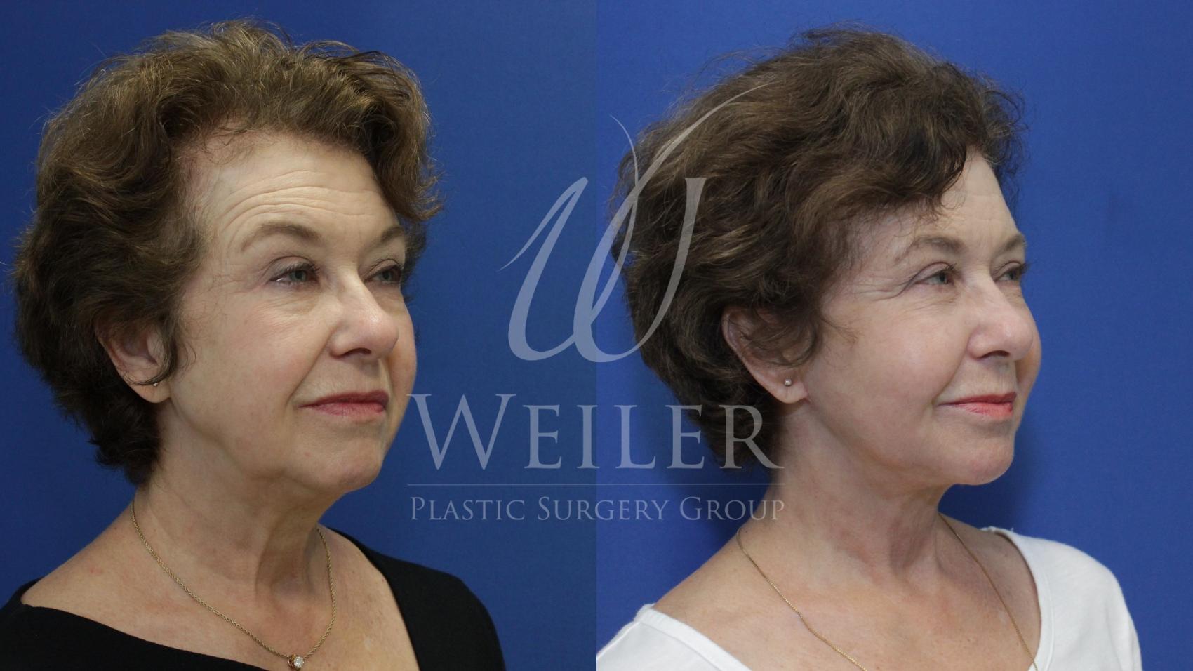 Before & After Facelift Case 742 Right Oblique View in Baton Rouge, New Orleans, & Lafayette, Louisiana