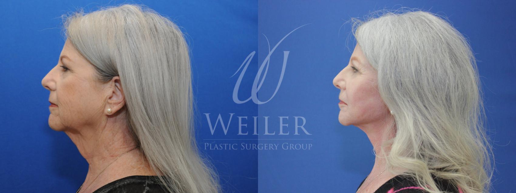 Before & After Facelift Case 811 Left Side View in Baton Rouge, New Orleans, & Lafayette, Louisiana