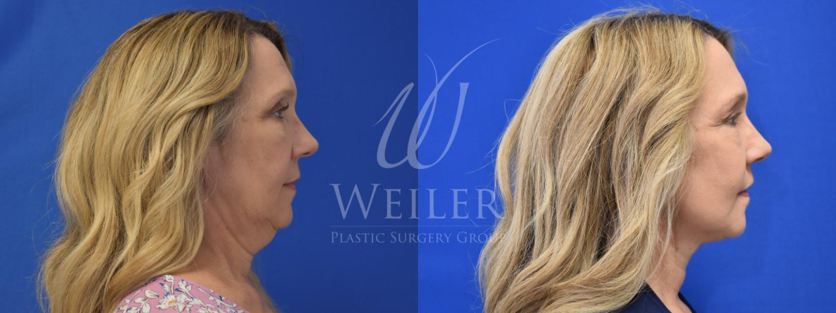 Before & After Facelift Case 828 Right Side View in Baton Rouge, New Orleans, & Lafayette, Louisiana