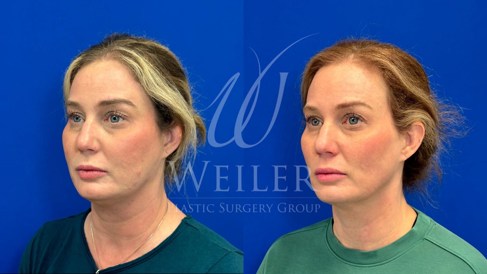 Before & After Restylane® Case 1505 Left Oblique View in Baton Rouge, New Orleans, & Lafayette, Louisiana