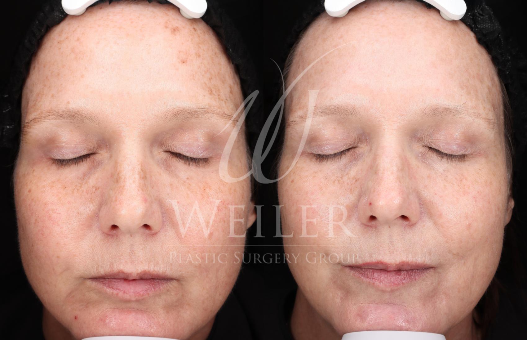 Before & After IPL Photorejuvenation Case 1706 Front View in Baton Rouge, New Orleans, & Lafayette, Louisiana