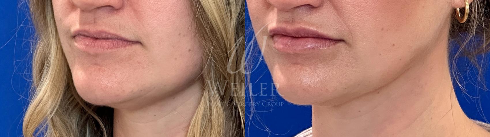Before & After Restylane® Case 1451 Left Side View in Baton Rouge, New Orleans, & Lafayette, Louisiana