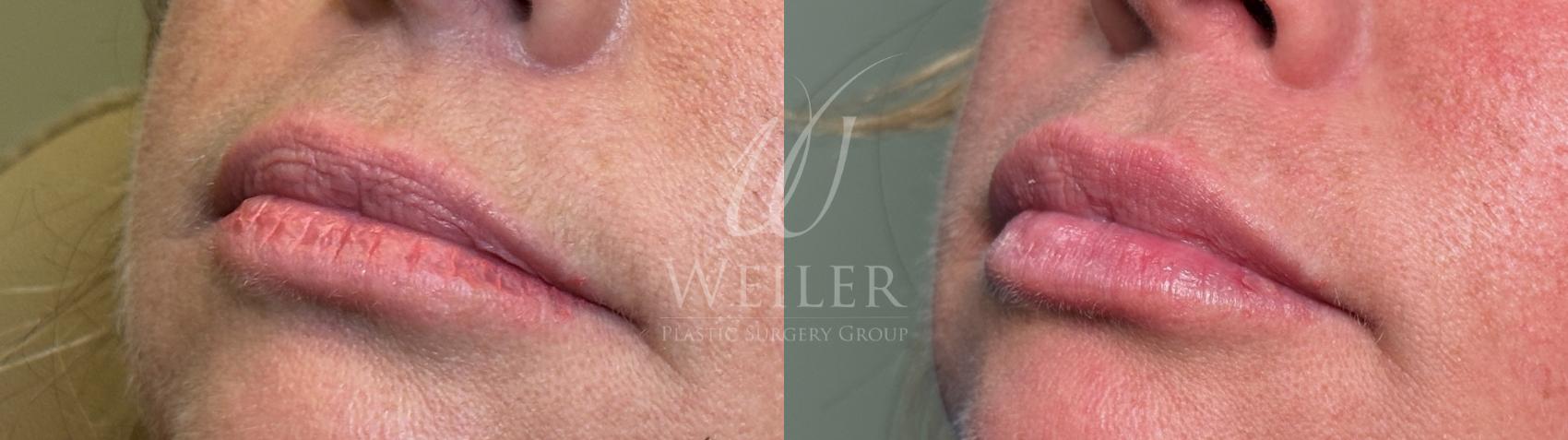 Before & After Lip Augmentation Case 1556 Left Oblique View in Baton Rouge, New Orleans, & Lafayette, Louisiana