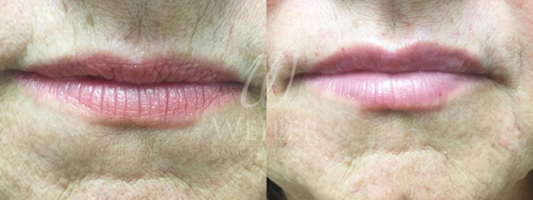 Before & After Lip Augmentation Case 3 View #1 View in Baton Rouge, New Orleans, & Lafayette, Louisiana
