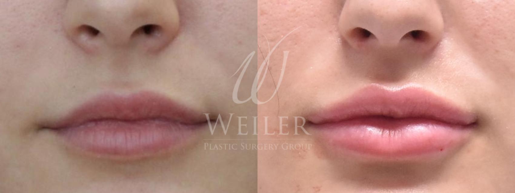 Before & After Lip Augmentation Case 616 Front View in Baton Rouge, New Orleans, & Lafayette, Louisiana
