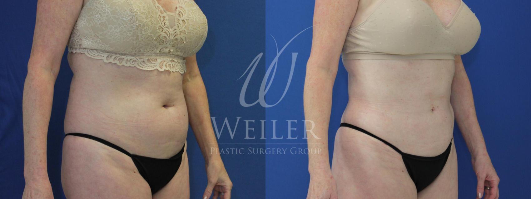 Before & After Liposuction Case 495 Right Oblique View in Baton Rouge, Louisiana