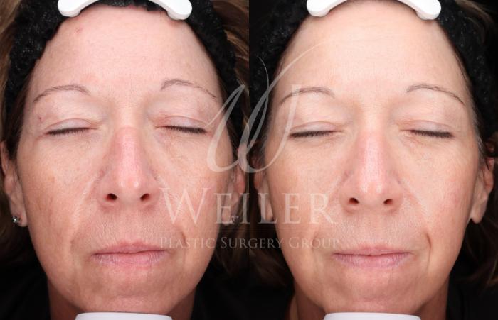 Before & After Lutronic Ultra™ Laser Case 1482 Front View in Baton Rouge, New Orleans, & Lafayette, Louisiana