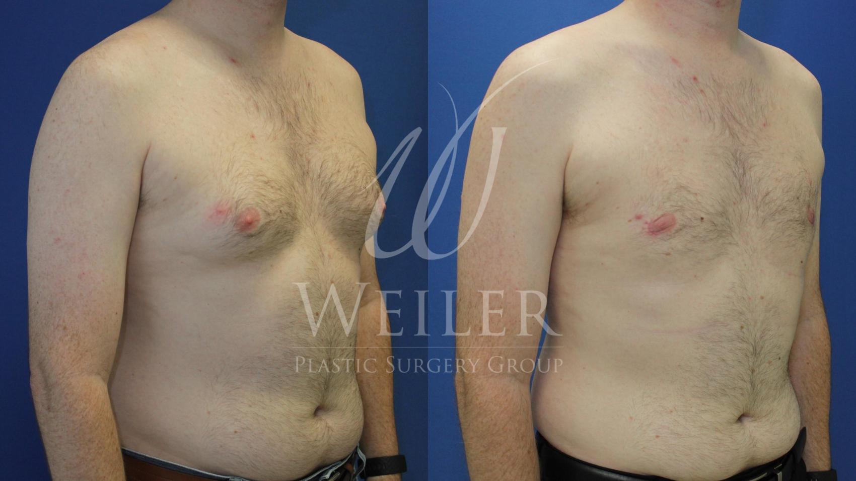 Before & After Male Breast Reduction Case 546 Right Oblique View in Baton Rouge, New Orleans, & Lafayette, Louisiana