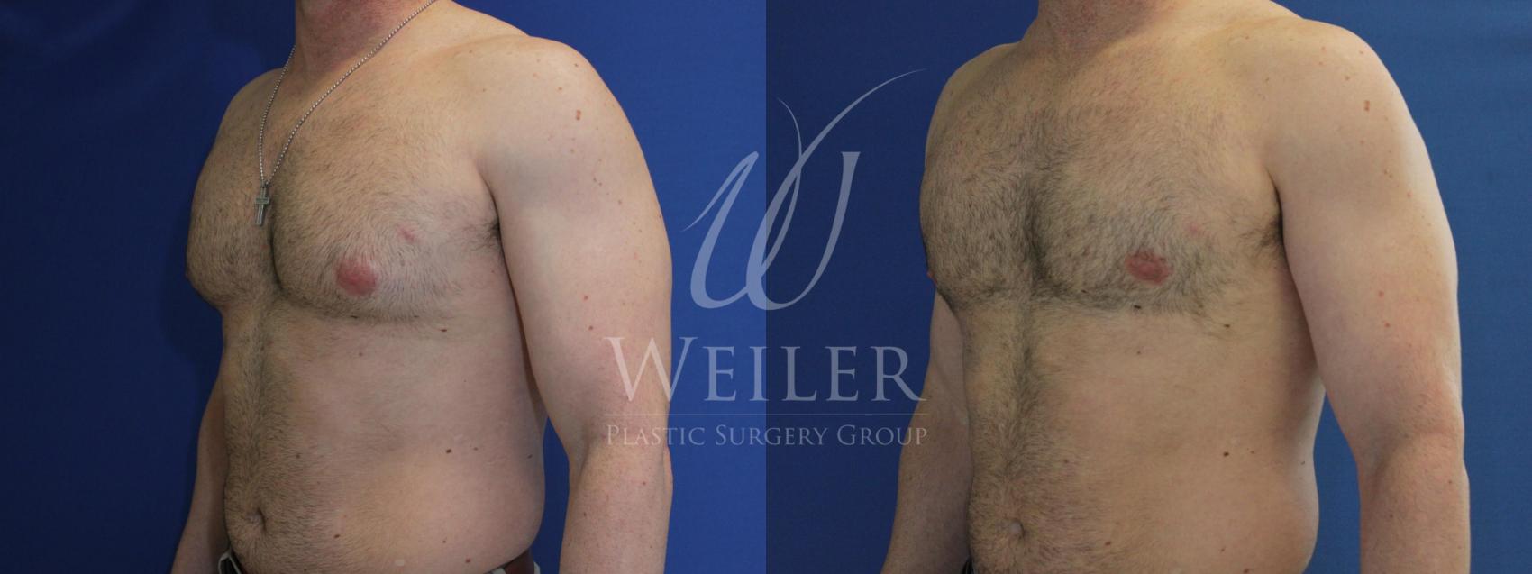 Before & After Male Breast Reduction Case 556 Left Oblique View in Baton Rouge, New Orleans, & Lafayette, Louisiana