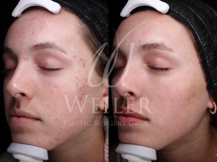 Before & After Microneedling Case 1657 Left Oblique View in Baton Rouge, New Orleans, & Lafayette, Louisiana