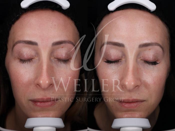 Before & After Microneedling Case 1729 Front View in Baton Rouge, New Orleans, & Lafayette, Louisiana