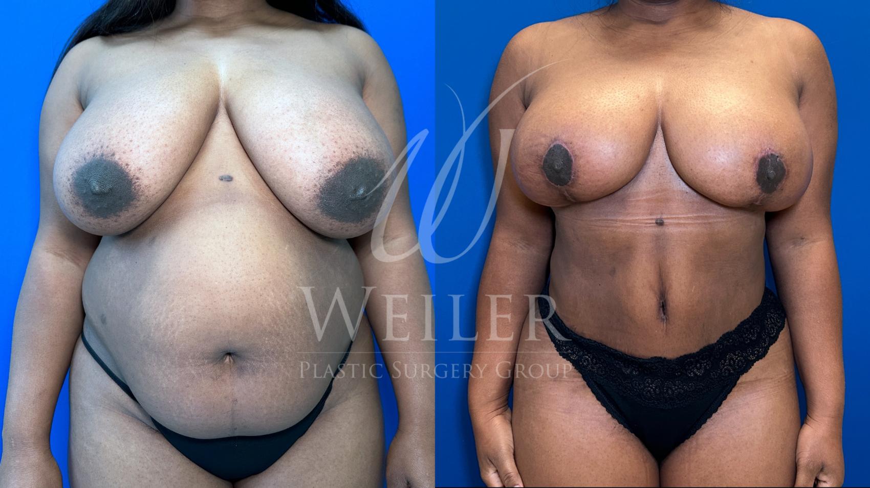 Before & After Mommy Makeover Case 1493 Front View in Baton Rouge, New Orleans, & Lafayette, Louisiana