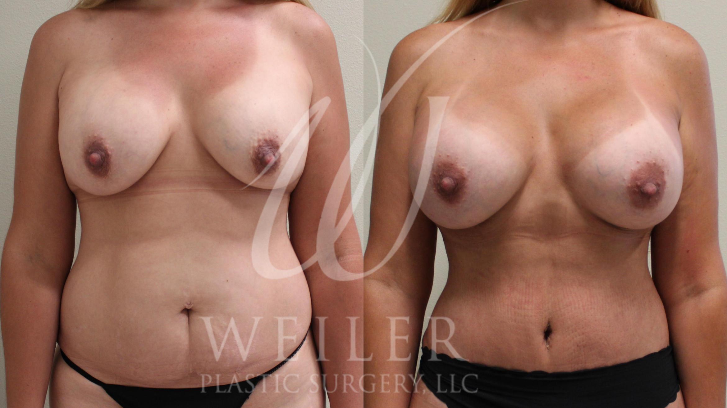 Mommy Makeover Before & After Photo | Baton Rouge, Louisiana | Weiler Plastic Surgery