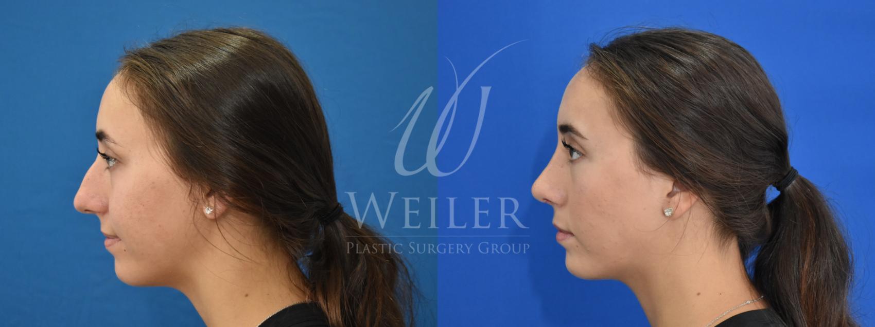 Before & After Rhinoplasty Case 881 Left Side View in Baton Rouge, New Orleans, & Lafayette, Louisiana