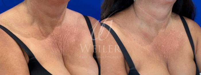 Before & After Sculptra Case 1602 Right Oblique View in Baton Rouge, New Orleans, & Lafayette, Louisiana