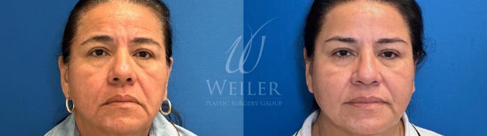 Before & After Sofwave Case 1668 Front View in Baton Rouge, New Orleans, & Lafayette, Louisiana