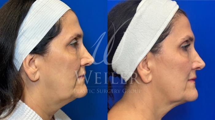 Before & After Sofwave Case 1669 Right Side View in Baton Rouge, New Orleans, & Lafayette, Louisiana