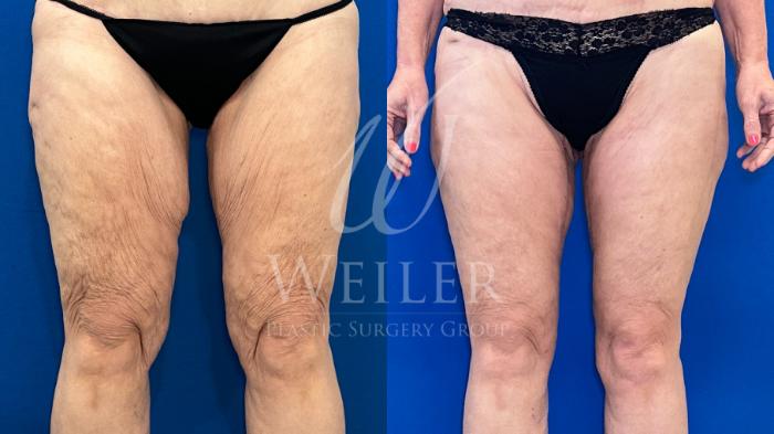Before & After Thigh Lift Case 1315 Front View in Baton Rouge, New Orleans, & Lafayette, Louisiana