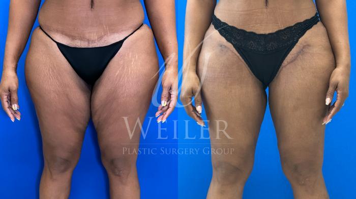 Before & After Thigh Lift Case 1664 Front View in Baton Rouge, New Orleans, & Lafayette, Louisiana
