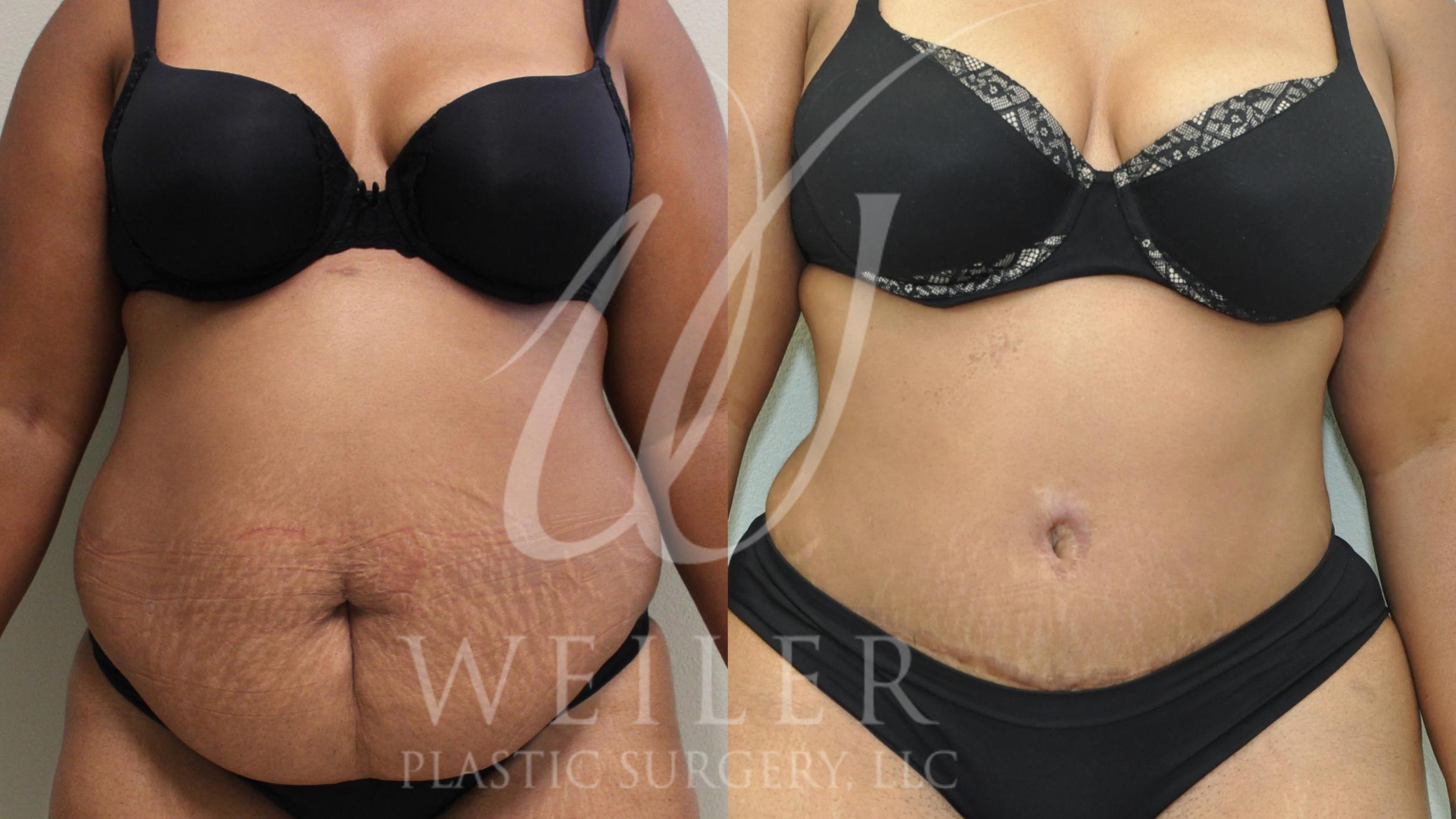 Tummy Tuck Before & After Photo | Baton Rouge, Louisiana | Weiler Plastic Surgery