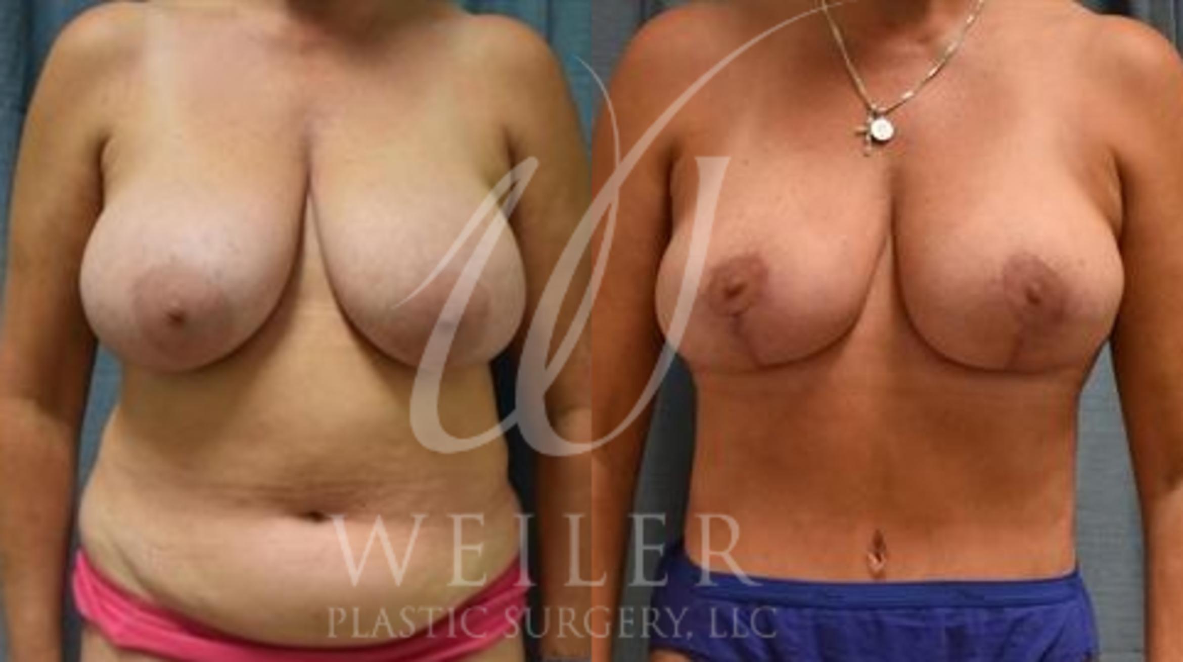 Tummy Tuck Before & After Photo | Baton Rouge, Louisiana | Weiler Plastic Surgery